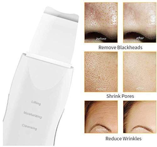 Ultrasonic Facial Skin Scrubber – Deep Pore Cleanser & Blackhead Remover | Lifting & Hydrating Beauty Device